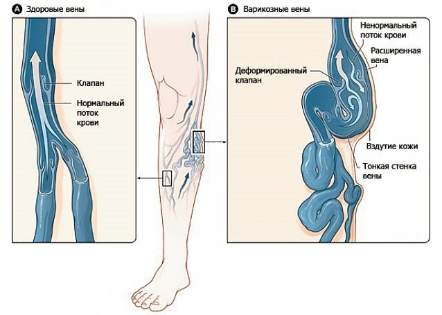 Выступающие вены на ногах: что делать?