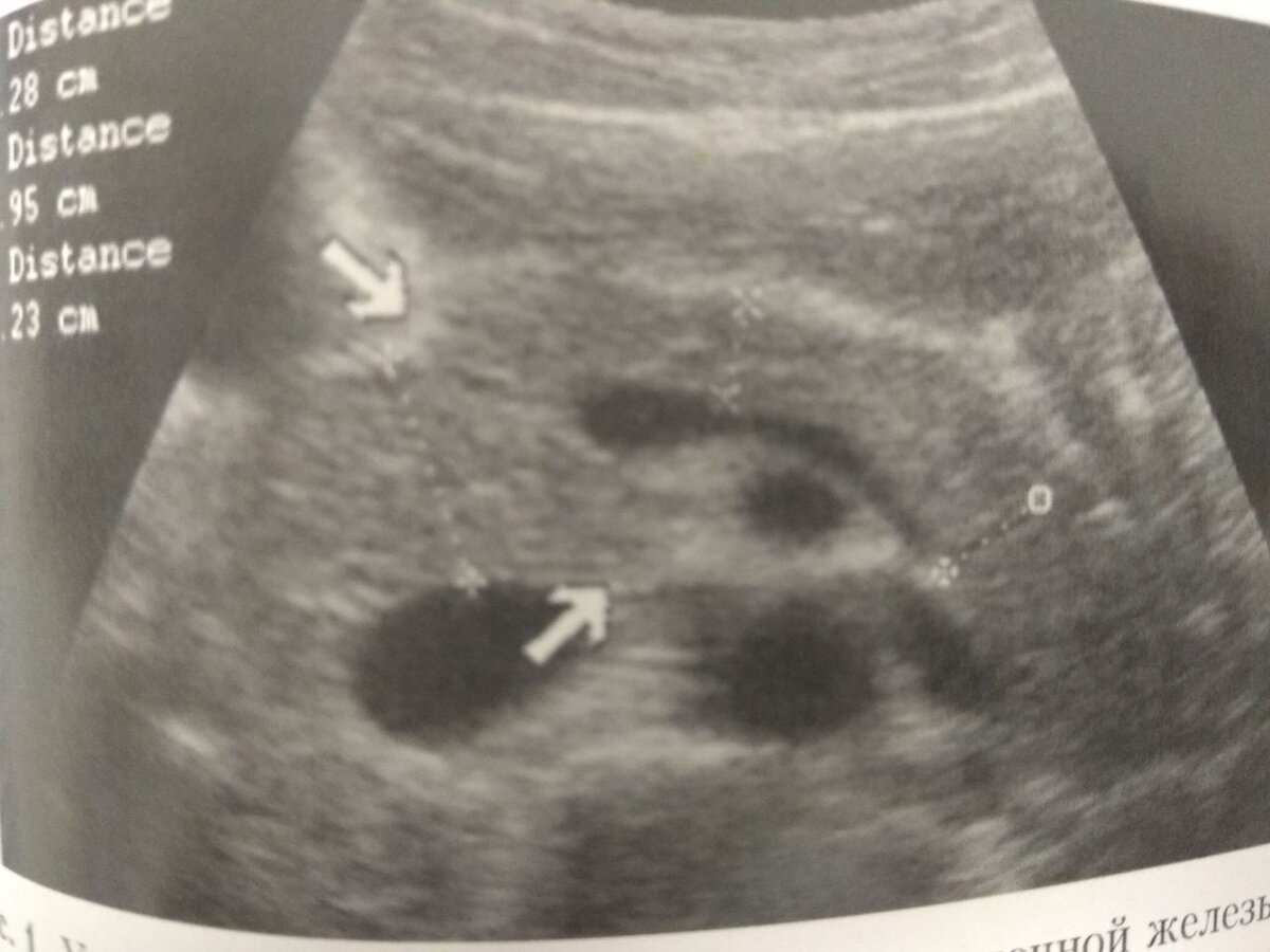 Источник: Ультрасонография органов желудочно-кишечного тракта Р.Я Абдуллаев
