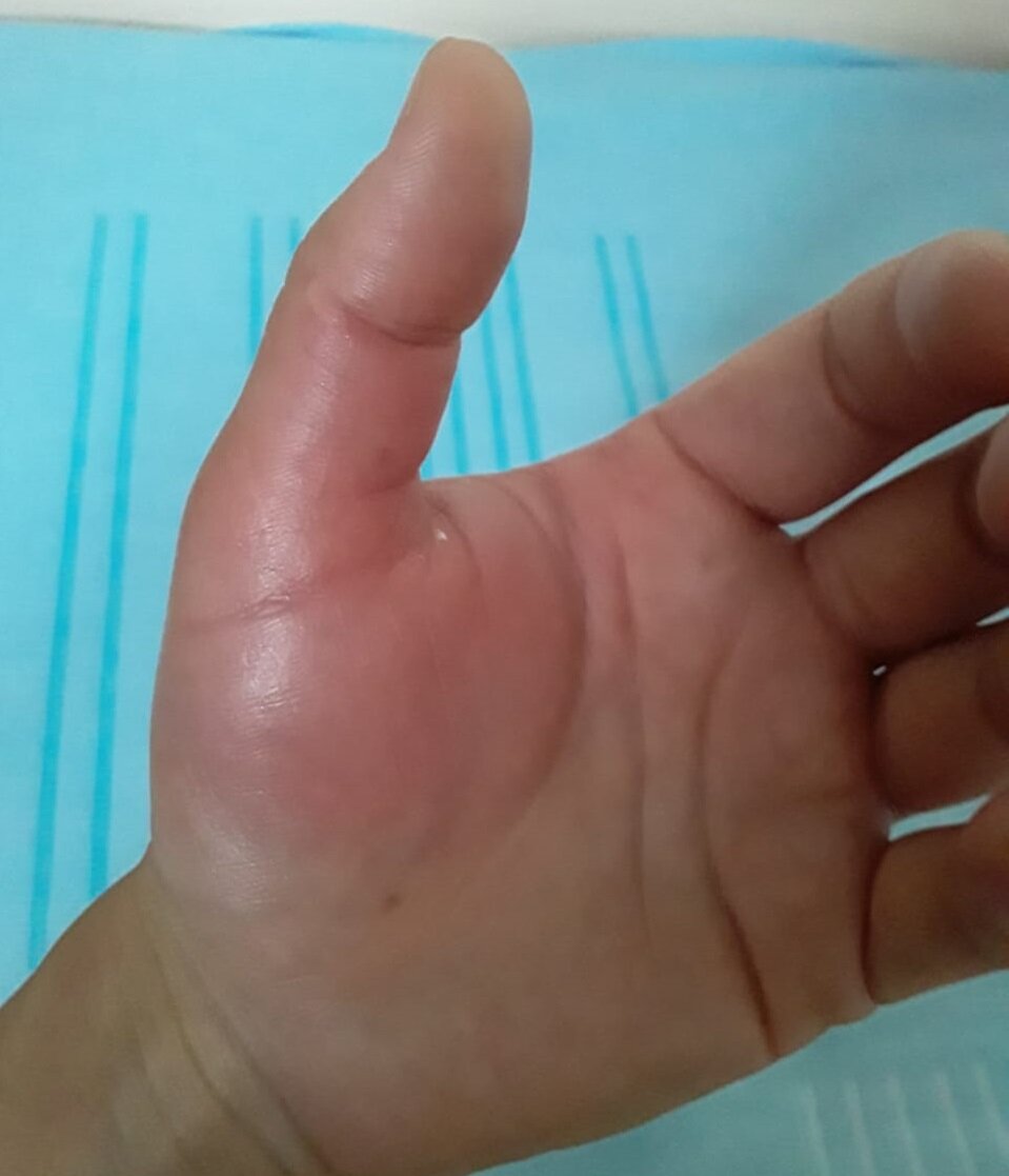 Моя рука после укуса сколопендры