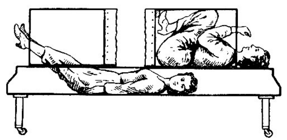 Эта невероятная история случилась в 1995 году. Китаец по имени Пенг Шулин (Peng Shulin) пережил страшную автокатастрофу, во время которой его перерубило пополам при столкновении с грузовиком. Целых 20 врачей участвовали в операции по пересадке кожи с головы в район торса, и в итоге Шулин все же выжил. Медики называют это настоящим чудом. Какое-то время китаец был прикован к постели, но сейчас он может вновь ходить, хотя и не без помощи протезов.