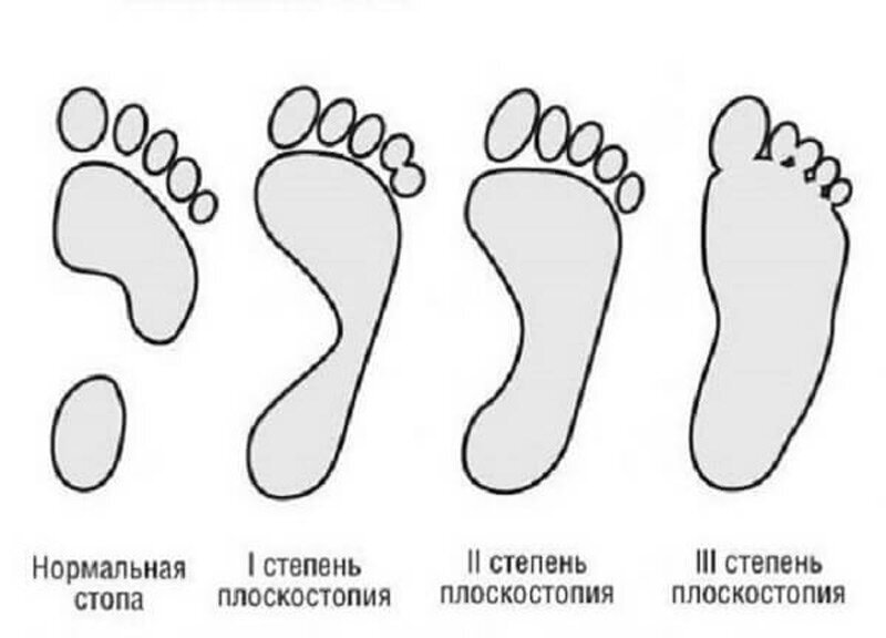 Как должен выглядеть пенис у детей Не носите балетки! Делюсь горьким опытом спустя 4 лет носки Анна Макарова Дзен