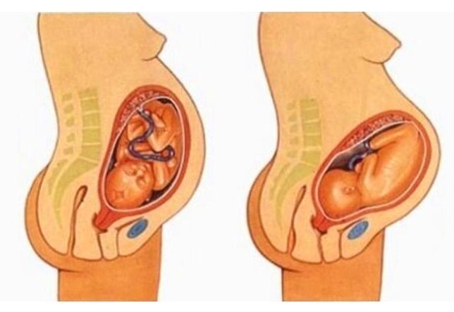 На картинке пример опущения живота.