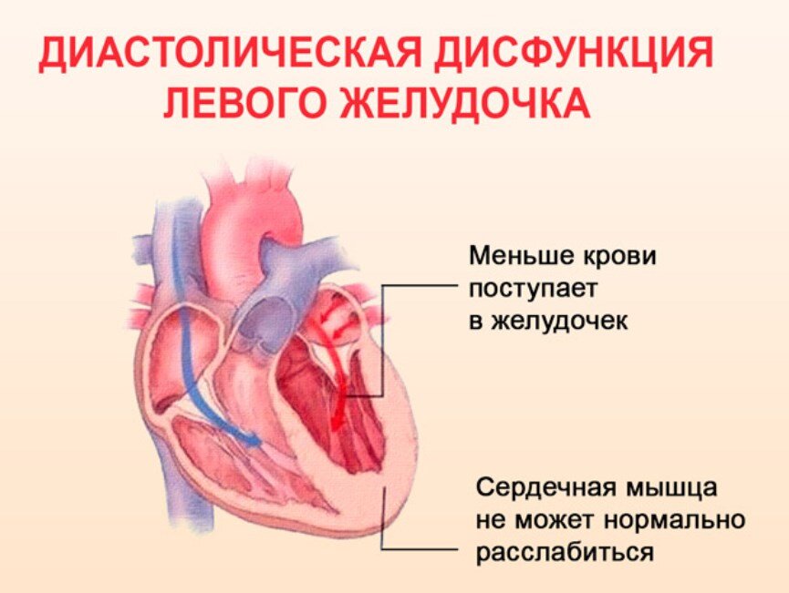 Желудочка сердца расширена. Нарушение диастолы левого желудочка. Диастолическая дисфункция левого желудочка 1 типа причина. Диастолическая дисфункция левого желудочка 2 степени. Типы дисфункции левого желудочка.