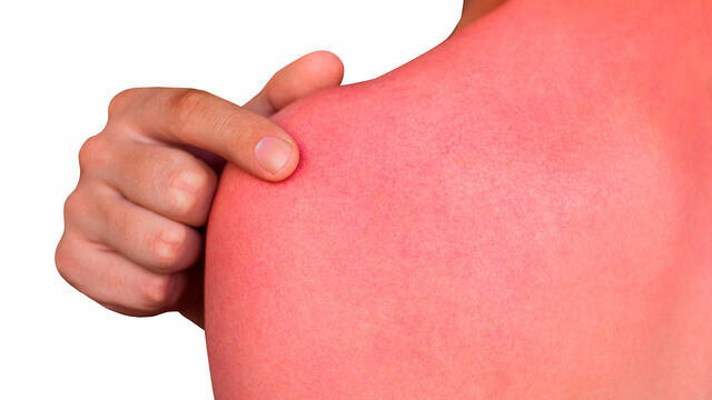 Кожа ребенка после солнечного ожога.