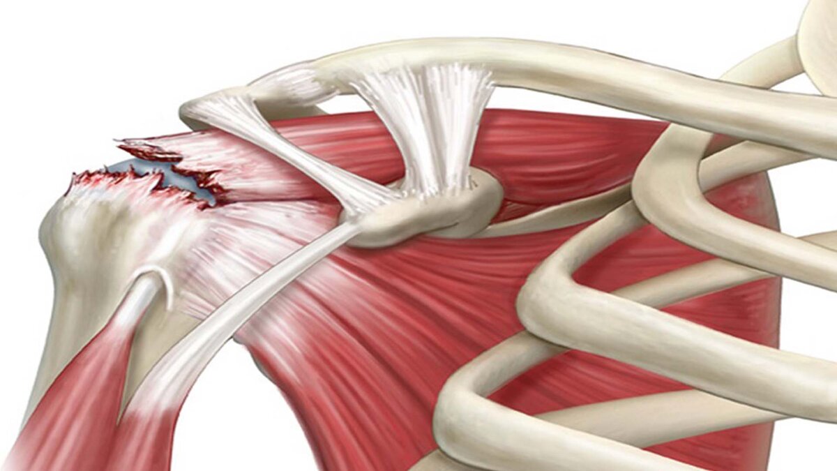 Сухожилие надостной мышцы фото