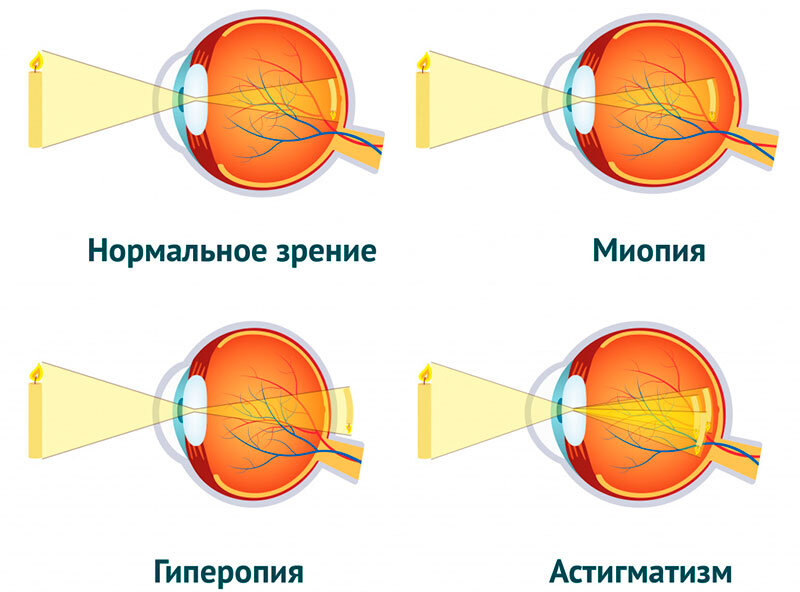 Норма и аномалии рефракции