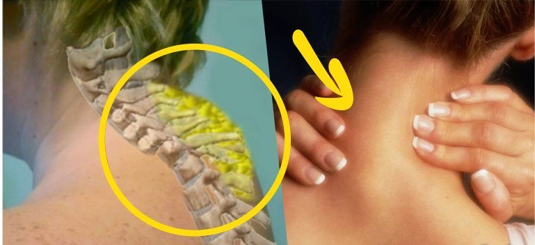 Как убрать ОТЛОЖЕНИЕ СОЛЕЙ на шейном отделе позвоночника. Курс лечения 7-10 проц