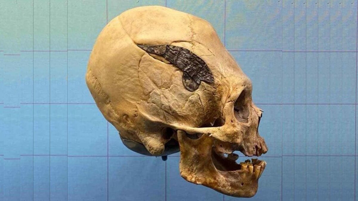 Череп с металлической пластиной 2 тысячи лет назад