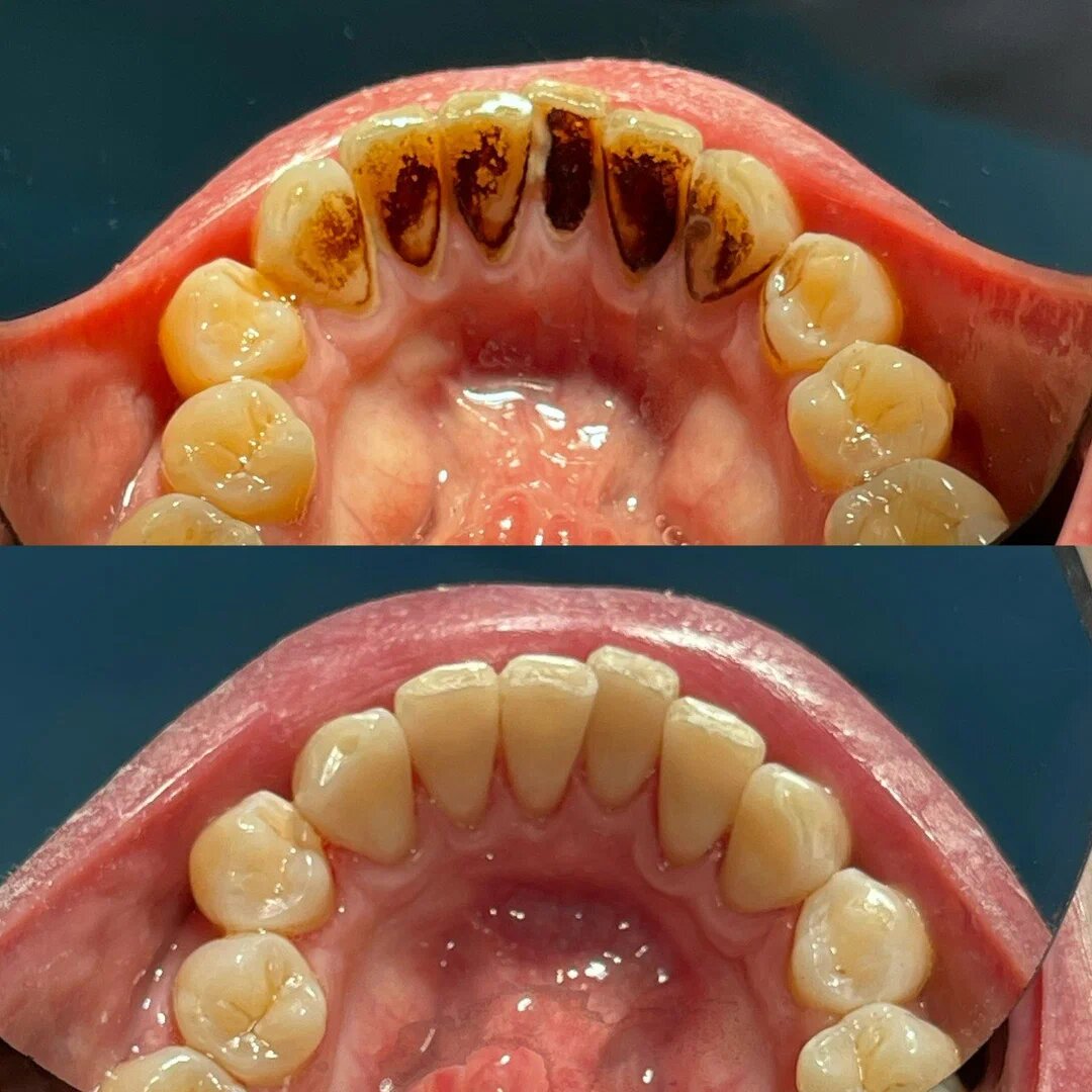 Зубы до и после профгигиены