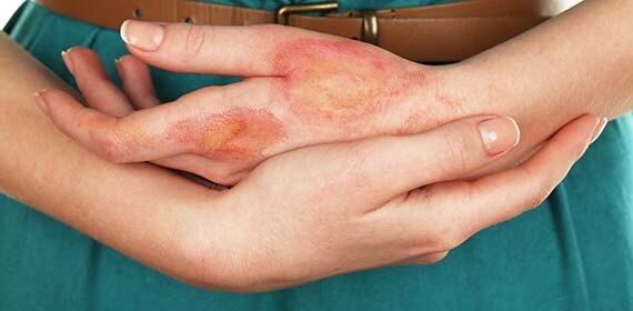 Начинающийся псориаз на кистях рук, переходящий в последствие до локтя.