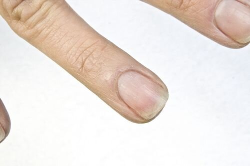 Основные признаки таких ногтей:
 
⚡безжизненные
⚡ часто ломаются выше точек вроста
⚡ трескаются и скручиваются
⚡ слоятся
⚡ шероховатая поверхность
⚡ сухая кутикула.
