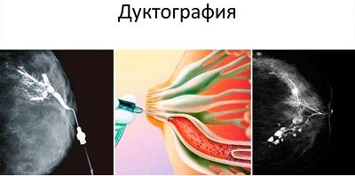 дуктография