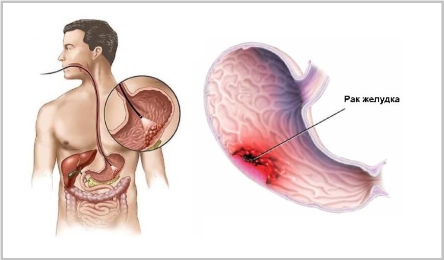 Какие Симптомы Бывают При Раке Желудка