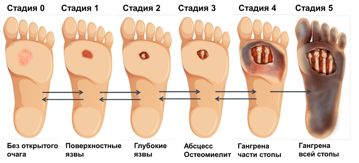 Диабетическая стопа: причины, симптомы, виды, лечение, когда нужна ампутация, ка