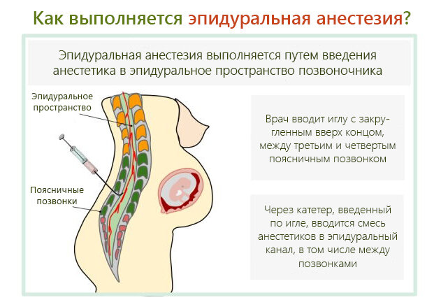 почему после эпидуралки болит спина | Дзен