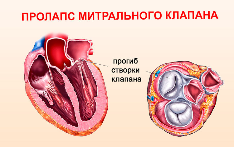 Пролапс митрального клапана: причины, симптомы, диагностика, лечение - центр «Меддиагностика»