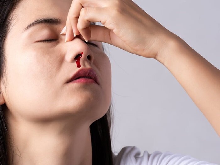 Фотон Неправильное положение головы при носовом кровотечении.