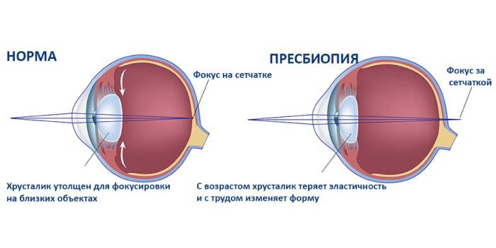 Пресбиопия глаз. Возрастная пресбиопия. Пресбиопия механизм формирования. Пресбиопия возраст. Пресбиопия глаз коррекция.
