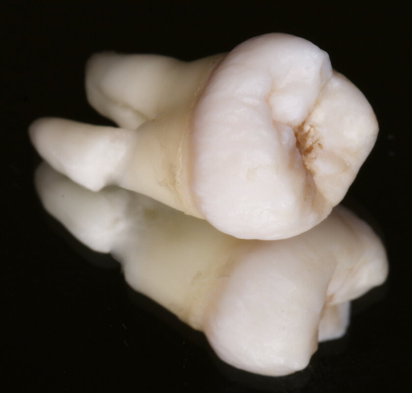 Так выглядит настоящий депульпированный зуб 