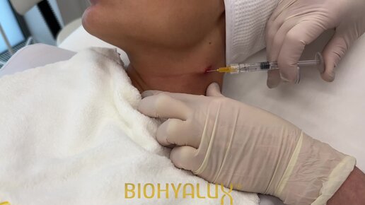 Коррекция «колец Венеры» в канюльной технике препаратом BioHyalux Fine Lines