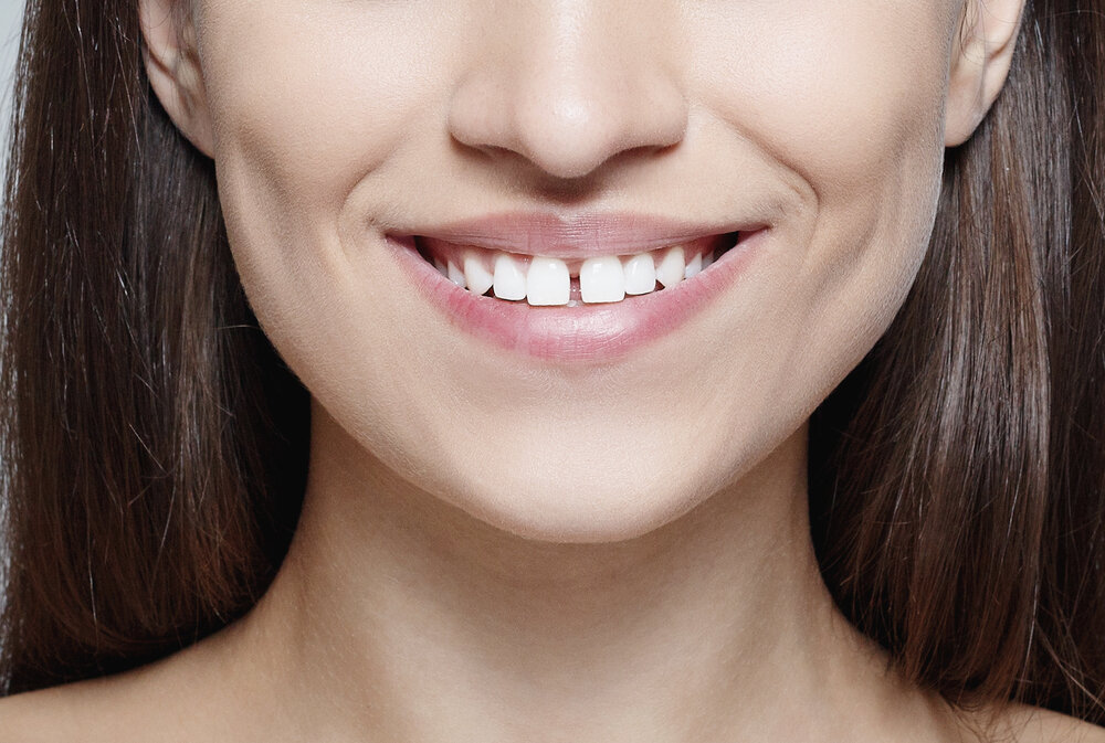 Капы (элайнеры) представляют собой прозрачные полимерные накладки на зубной ряд, которые плотно его охватывают и оказывают механическое воздействие, поворачивая зубы до необходимой позиции.-2