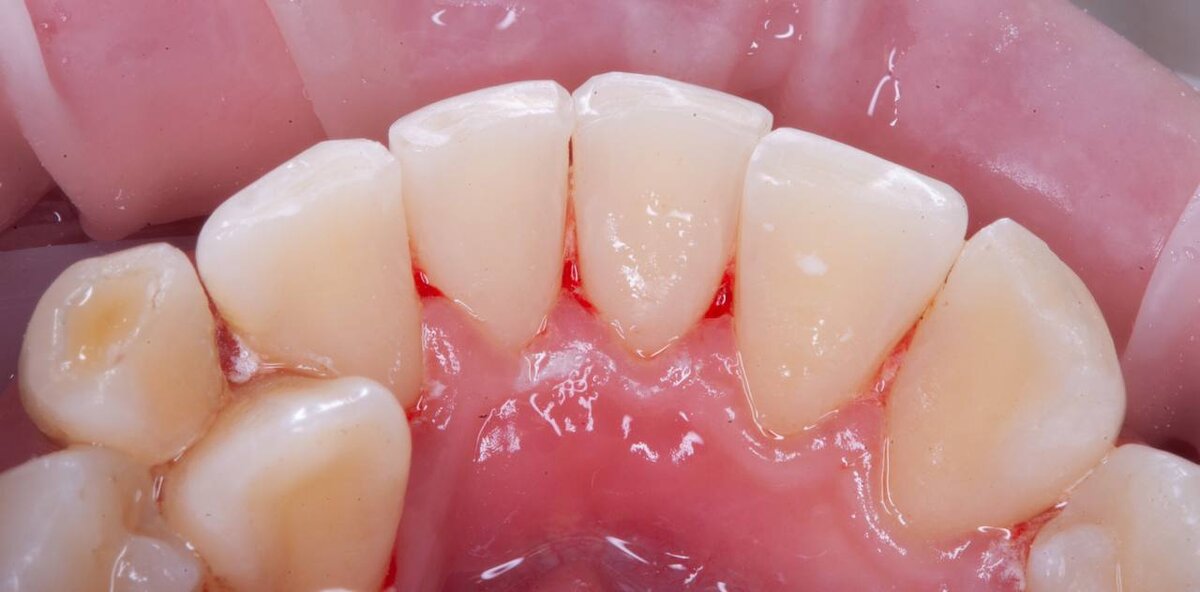 На данной фотографии, фото после проведения процедуры проф. гигиены. Фотографии из личного архива пациентов , не взятый из интернета. Наглядный пример «до» - «после».