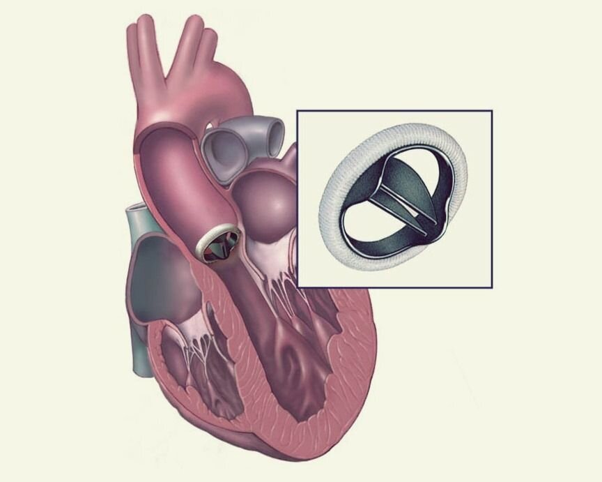 Стеноз и регургитация. Как запомнить?