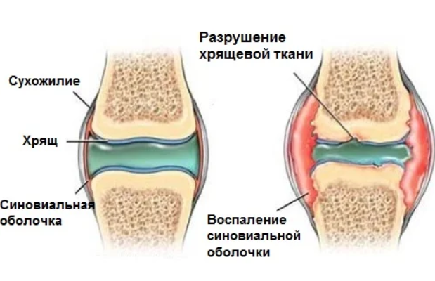 Восстановление хряща при остеоартрите