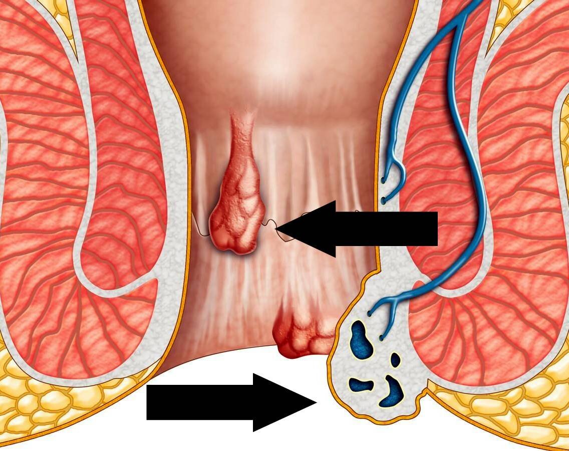 Как снять зуд в заднем проходе ᐉ Сеть аптек «Бажаємо здоров'я»