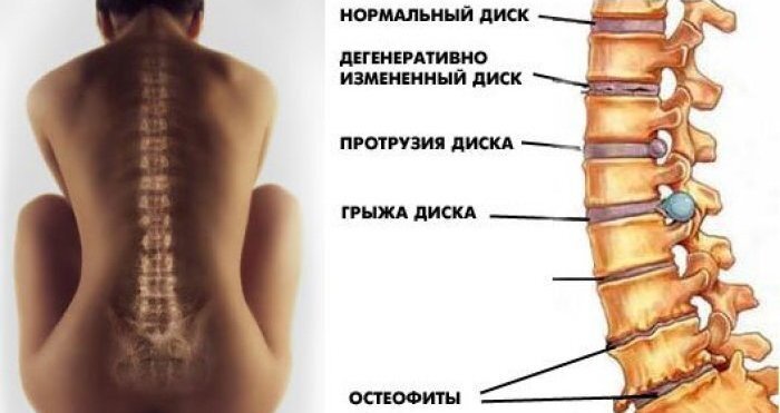 Люмбаго: симптомы, лечение, диагностика заболевания