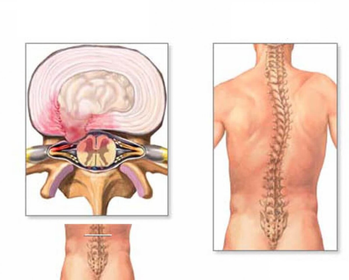 Боли в спине протрузии