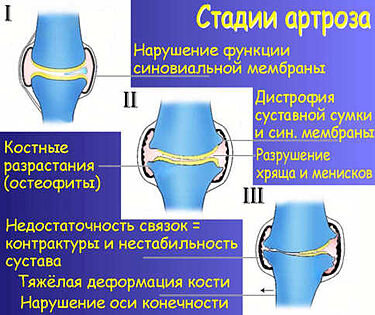 Артроз кистей рук