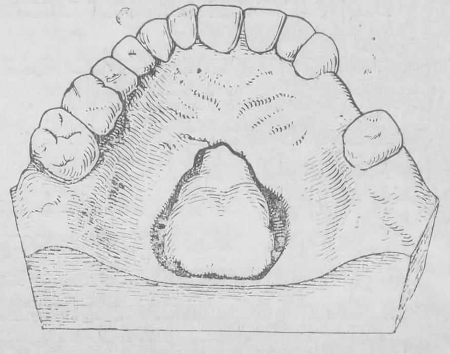 Верхнечелюстной отросток. Анатомия беззубых челюстей. Поднадкостничный абсцесс челюсти. Небный отросток верхней челюсти. Флегмона твердого неба.