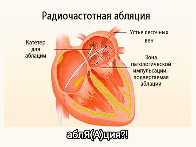 Радиочастотная абляция вен