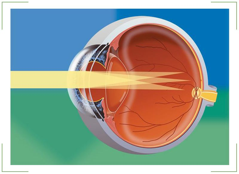 Как фокусируется изображение рассматриваемого предмета при астигматизме