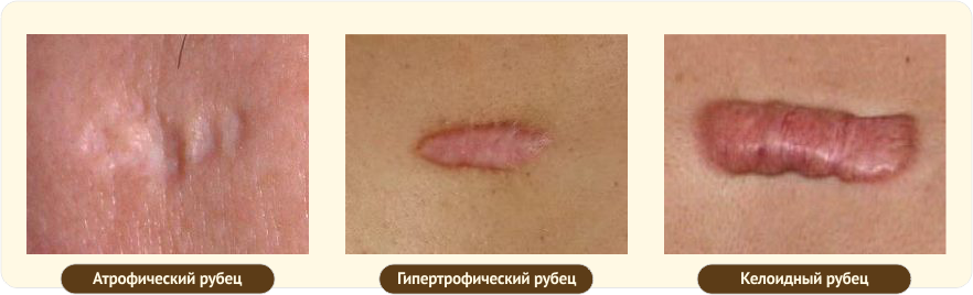 Виды рубцов