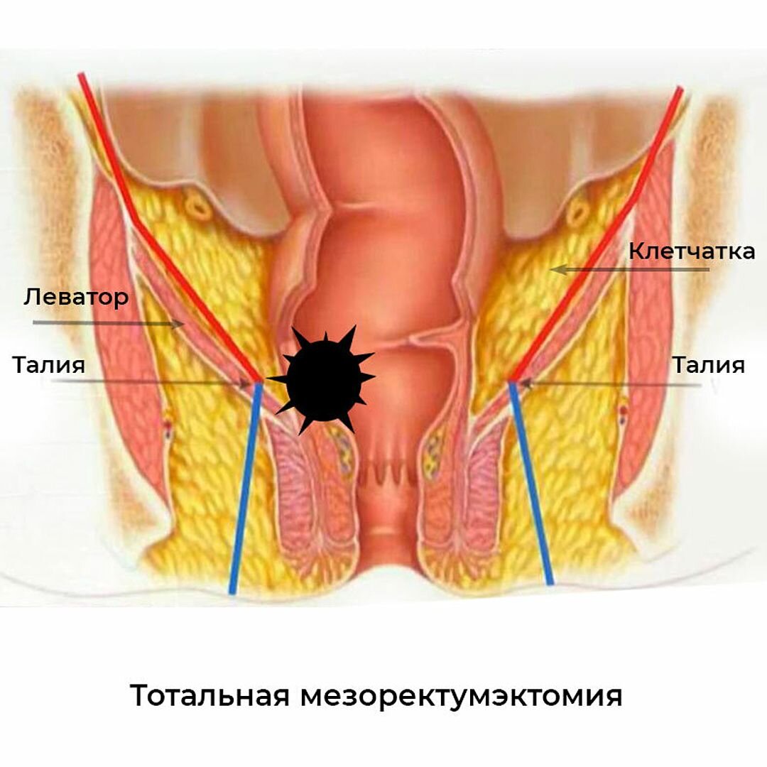 Экстирпация прямой кишки