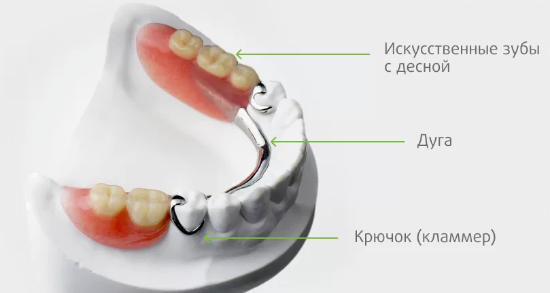 Пример частичного съемного зубного протеза: БЮГЕЛЬНЫЙ ПРОТЕЗ НА КЛАММЕРАХ