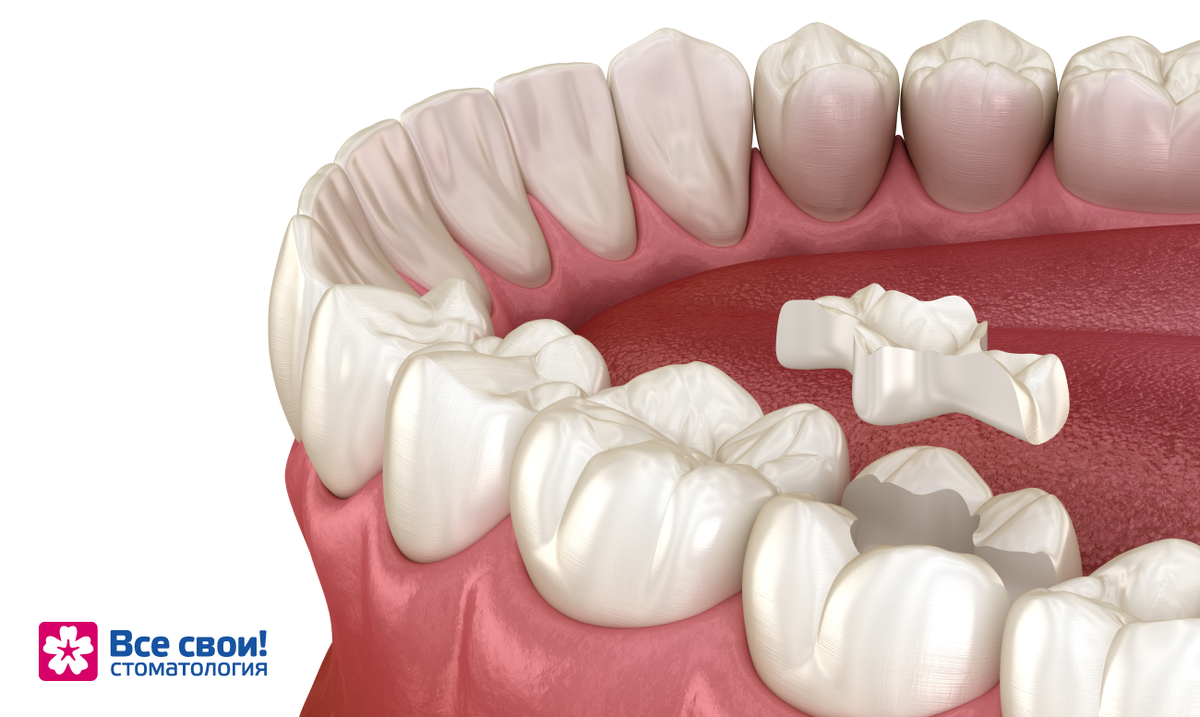 Пломба или вкладка: что выбрать | Все Свои! Стоматология | Дзен