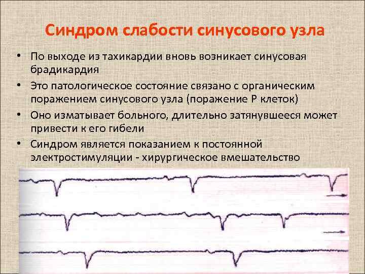 Синдром слабости синусового узла карта вызова смп