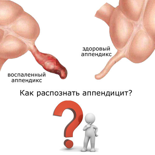 Что находится в аппендиците внутри Аппендицит: симптомы, где находится, операция с фото