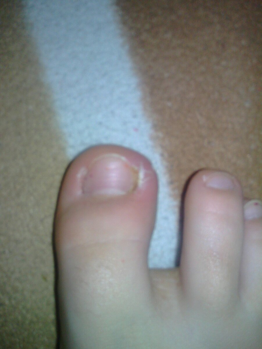 Вросший ноготь у подростка