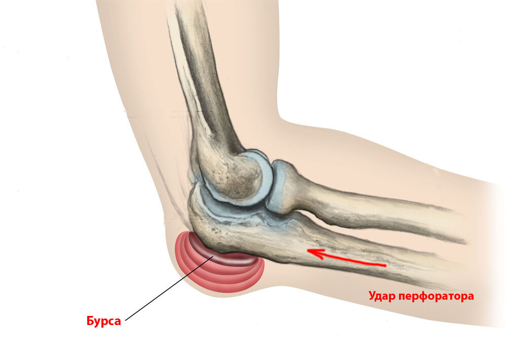 Бурсит локтевого отростка