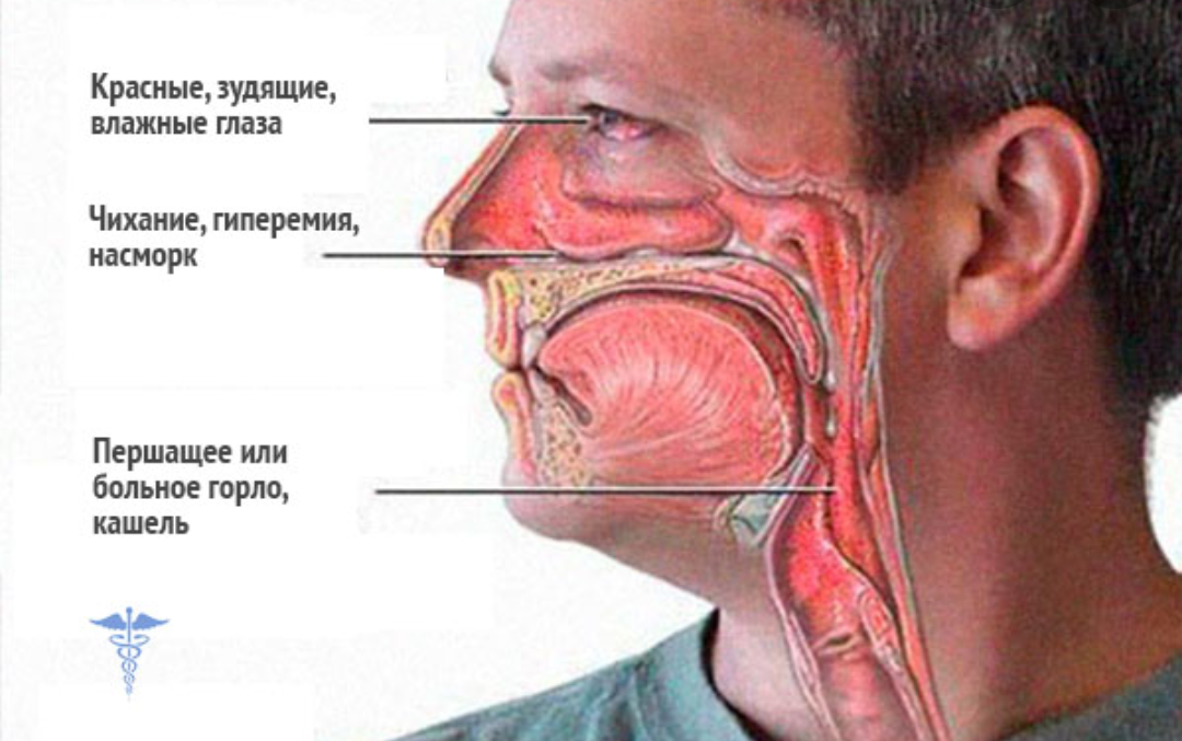 Отек квинке 