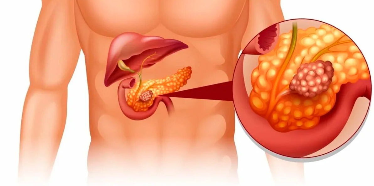 Фиброзные изменения поджелудочной железы