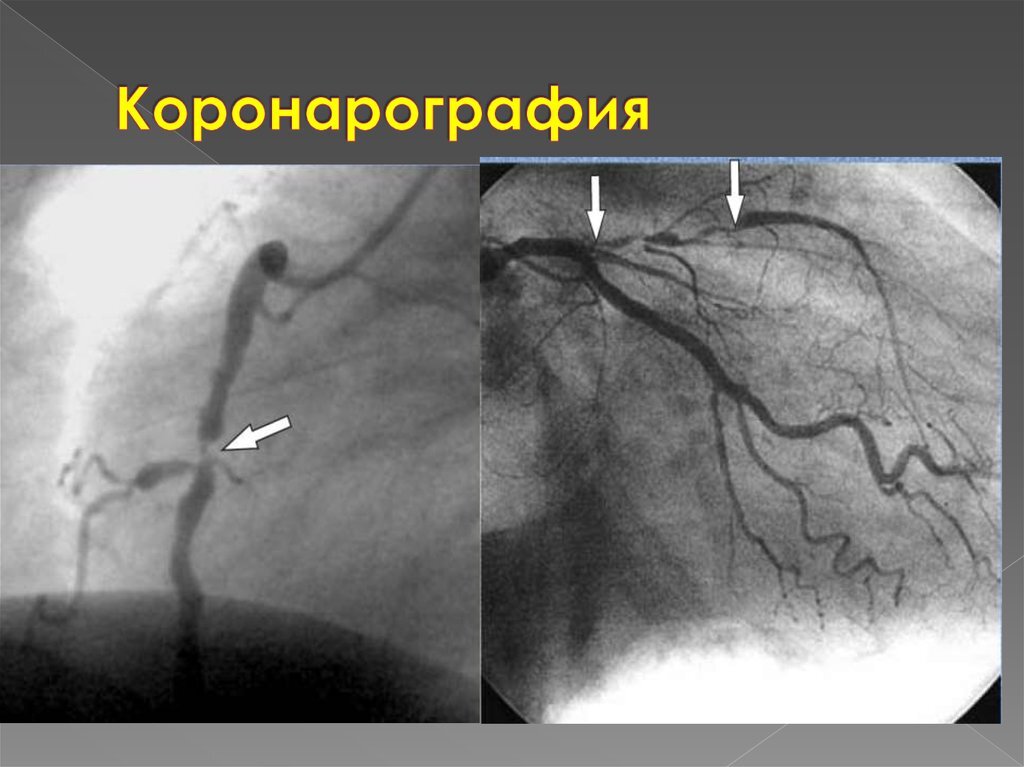 Стрелками показаны дефекты заполнения, соответствующие бляшкам в коронарных сосудах.