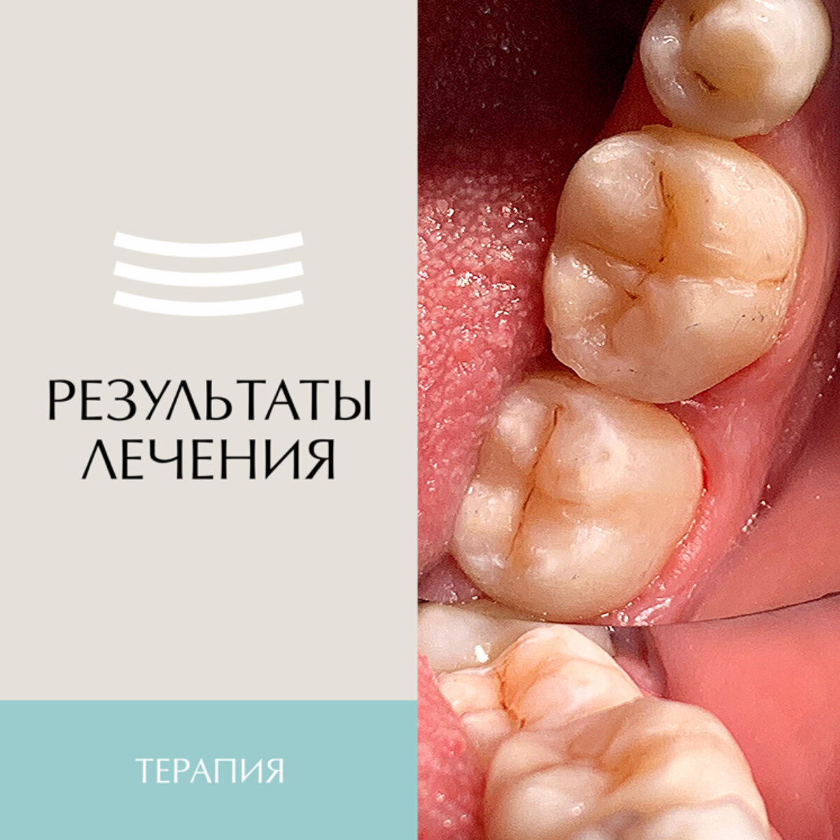 Клинический случай лечения кариеса жевательной группы зубов