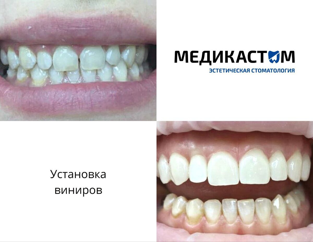 С помощью винирингового покрытия зубов можно скрыть все недостатки и получить идеальную белоснежную улыбку.