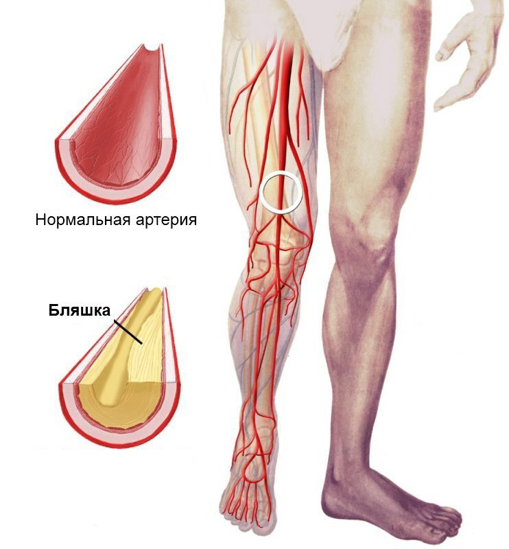 Атеросклероз ног.