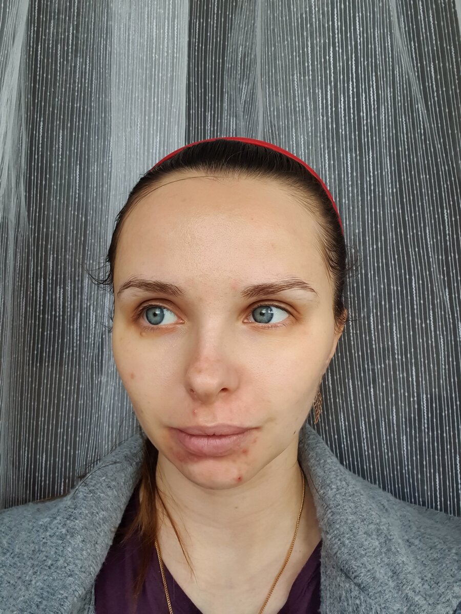 1 процедура. Фото прилагаю без фильтров и прочей редакции